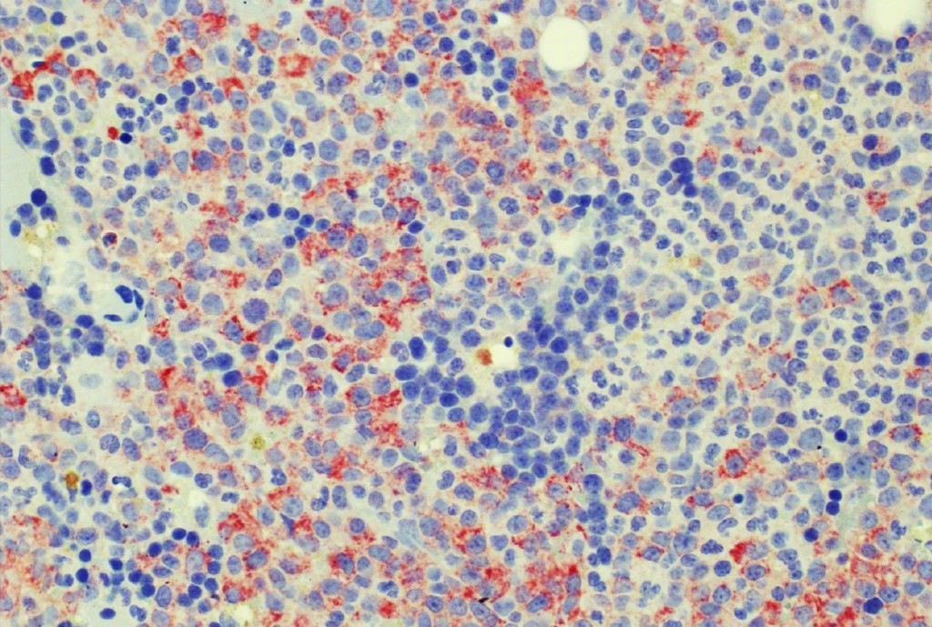 AML+H09-IHC